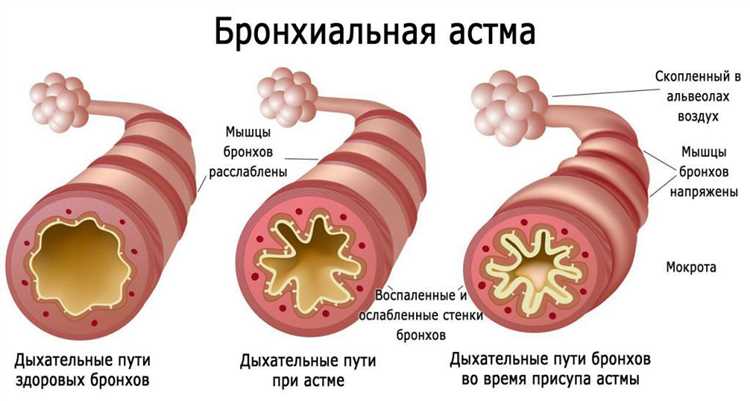 Справка о бронхиальной астме: как ее получить?